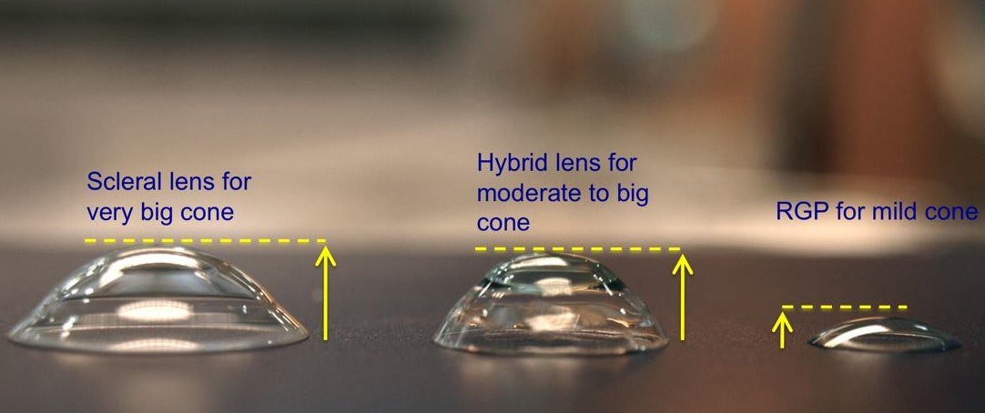 Чем отличаются линзы. Жёсткие контактные линзы для кератоконуса. Гибридные контактные линзы. Жесткие контактные линзы при кератоконусе. Твёрдые линзы для кератоконуса.